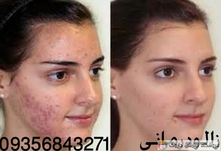 زالو درمانی جوش و لک صورت زالو درمانی جوش و لک صورت