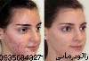 زالو درمانی جوش و لک صورت زالو درمانی جوش و لک صورت